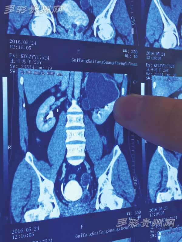 影像检查 资料显示，王开炼有4个肾，黑色阴影部分就是感染的左上肾。右边的两个肾在这份资料上已经重叠，看起来并不明显。