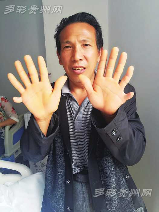 刘天书双手上的多指情况，他的每只手都有6个指头。