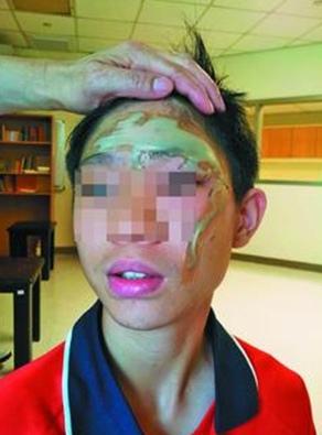 老师上课误把浓硫酸当醋酸男生不慎被喷中毁容