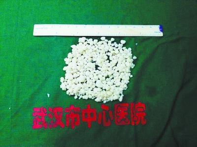 男孩髋关节掏出358颗“珍珠” 查出罕见软骨瘤