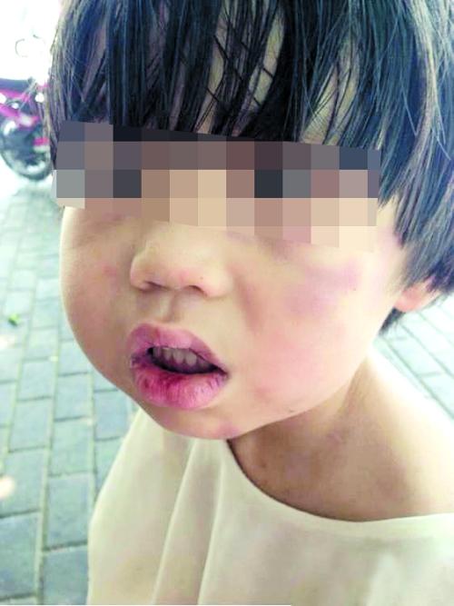 小涵脸颊、嘴唇上有瘀青和伤痕