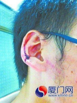 男子学车被教练揪破耳朵：买两包中华烟来