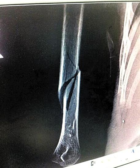 4岁男童幼儿园内被老师拉到监控死角扭断手臂