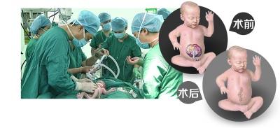 胎儿内脏裸露体外 医生产房内手术将其塞回(图)