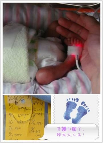 台湾最轻早产儿仅395克 重量相当于两个苹果