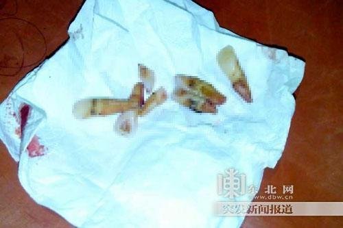 女子过马路被车撞掉7颗牙 无生命危险