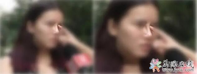 益阳一女子花18000元整容 不到3个月鼻梁开始游走