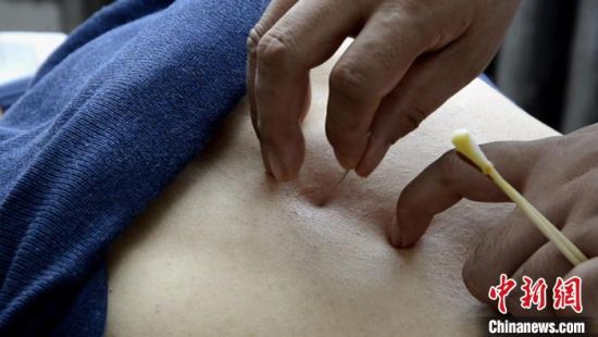 2020年10月29日,平凉市灵台县皇甫谧中医院正在为患者的灵台穴扎针。(资料图) 李亚龙 摄