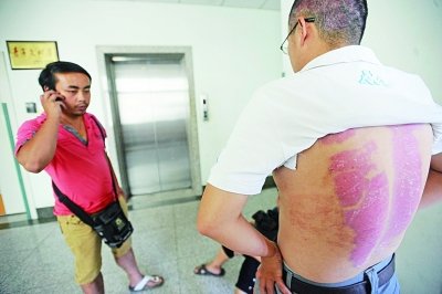 父亲全身重度烧伤 长子割皮次子卖房救父(图)