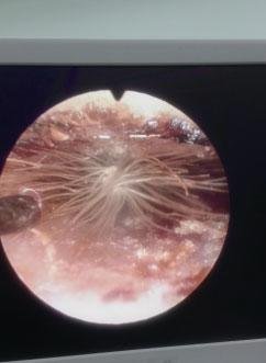 通过内窥镜屏幕可清晰看到耳道内“长”出的蒲公英 