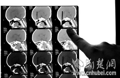 2岁男童吃面时摔倒 筷子插入颅内8厘米