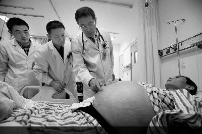 壮年男子因肝病出现肝腹水 肚子大如西瓜 